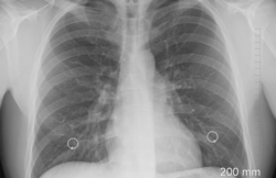 lung x-ray.png