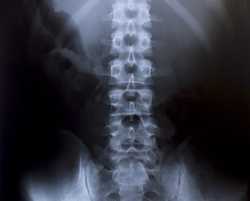pLowerBackXray_26479776_s-2.jpg